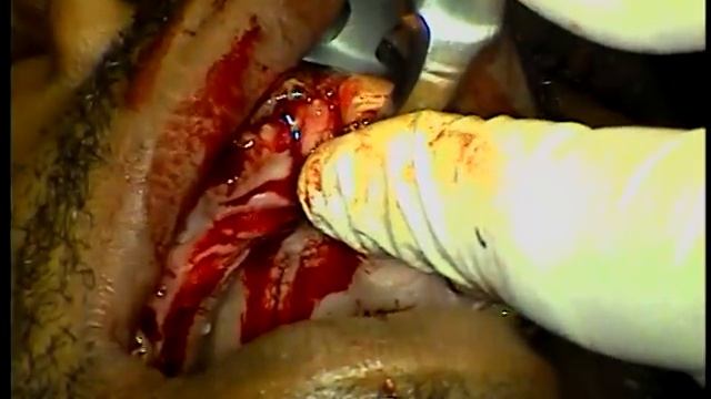 Extraction teeth #1-3, 5, 6-13, 15-16 with Physics Forceps смотреть онлайн
