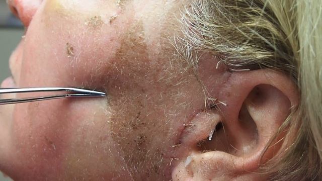 Peeling Skin from 30% TCA peel смотреть онлайн