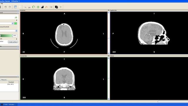 InVesalius 3 Beta 5 - Importing DICOM images and basic functions смотреть онлайн