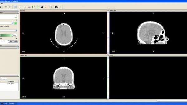 InVesalius 3 Beta 5 - Importing DICOM images and basic functions