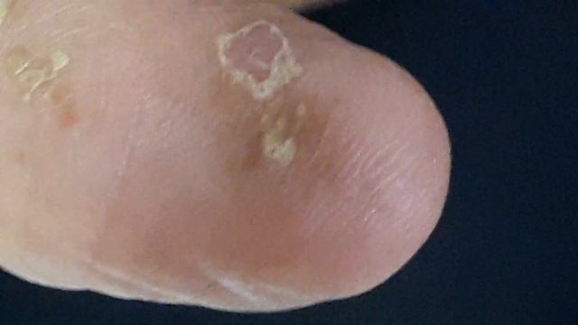 Tinea Manuum. Skin peeling'stypical of fungus смотреть онлайн