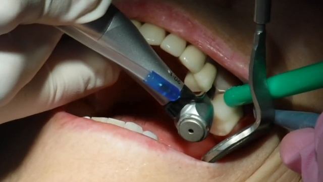Neodent Drive Flapless Implant Placement