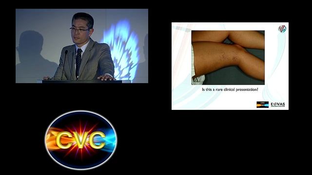 CVC 2015 Day 3 Superficial Venous Disease Session 3 смотреть онлайн