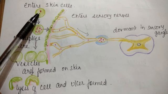 Herpes simplex - microbiology смотреть онлайн