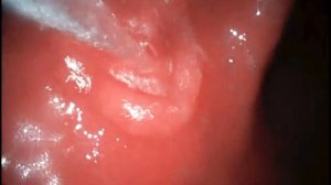 ЯЗВА 12-ПЕРСТНОЙ КИШКИ