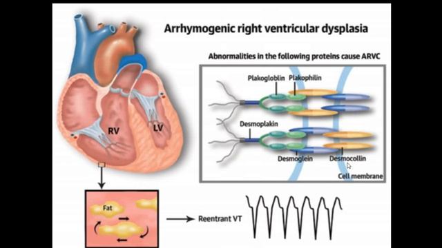 ARVD OR ARVD OR NAXOS SYNDROME 4TH YR смотреть онлайн