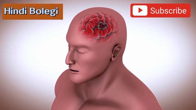 ब्रेन हेमरेज क्या है ? दिमाग की नस क्यों और कैसे फटती है ? Brain hemorrhage in hindi смотреть онлайн