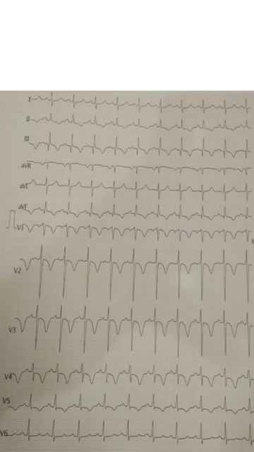 Pulmonary thrombosis S1Q3T3 pattern in ECG | #ecg #picu #hospital #shorts смотреть онлайн