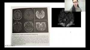 Ишемический инсульт и ТИА. Часть 2. Диагностика, лечение, вторичная профилактика.