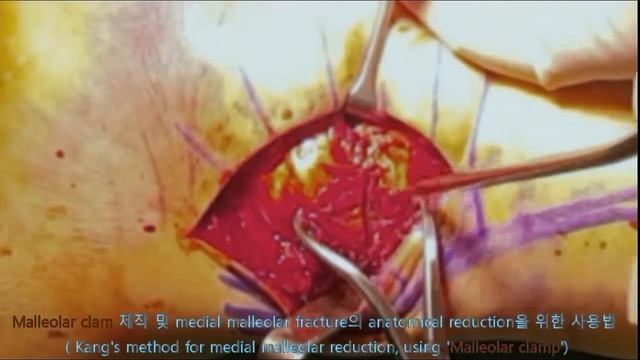 52.(의사용.Kang's surgery) 'Malleolar clamp'를 이용한 medial malleolar fx의 reduction [강찬.충남대.Chan KANG] смотреть онлайн