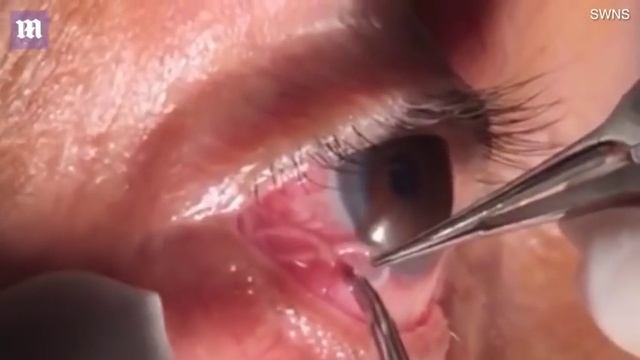 Хүний нүднээс 15 см урт шимэгч хойрхой салган авчээ смотреть онлайн