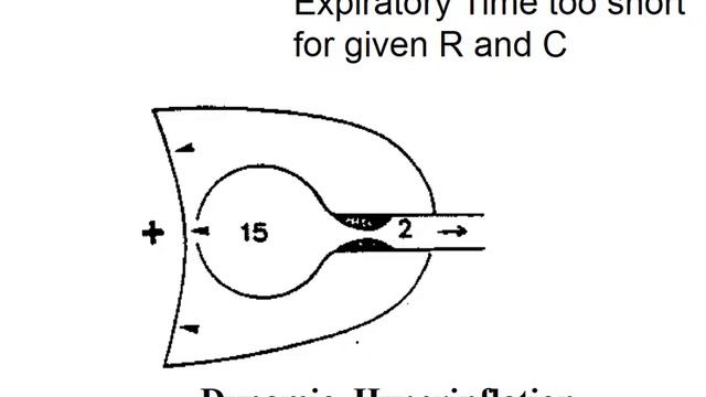 Pump failure A Pesenti 2017