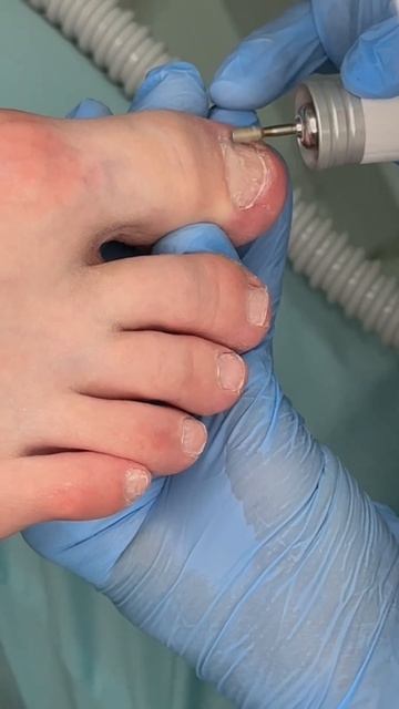 Больше о здоровье ногтей 🦶🏻 у нас на канале. ПОДПИСЫВАЙТЕСЬ ✔️ смотреть онлайн