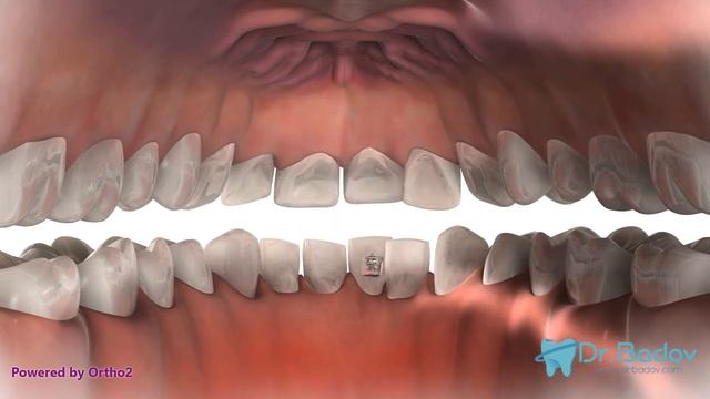 #лингвалнибрекети #брекети Лингвални брекети смотреть онлайн