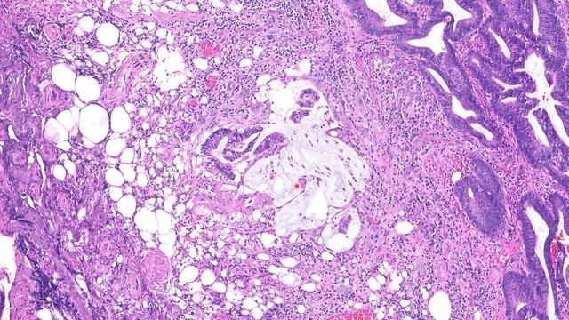 SSA with dysplasia and invasive adenocarcinoma (pT1) смотреть онлайн