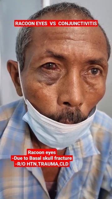 RED Eye |Conjuctivitis |Racoon Eyes 🩺🏥 смотреть онлайн