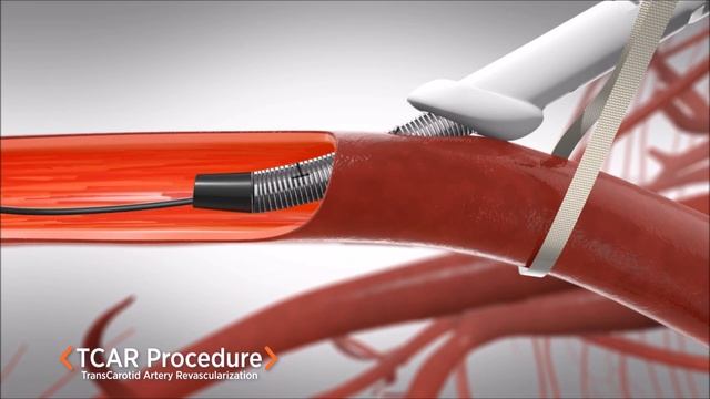 A New Approach to Treating Carotid Artery Disease смотреть онлайн