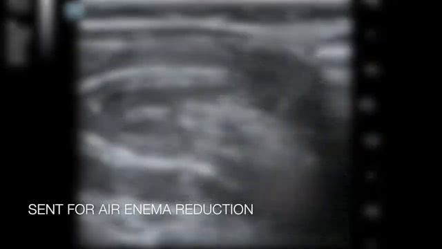 2 month old boy with Lethargy/Altered Mental Status x 1 day смотреть онлайн