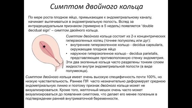 Ультразвуковые признаки беременности 4-5 недель2022 05 03 14 04 09 смотреть онлайн