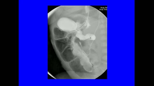 Volvulus Malrotation смотреть онлайн