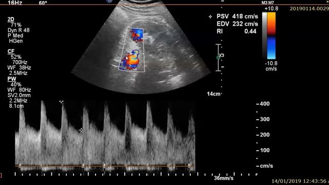 Renal Artery Stenosis Pitfalls...Renal doppler Study (SONOMASTER) смотреть онлайн