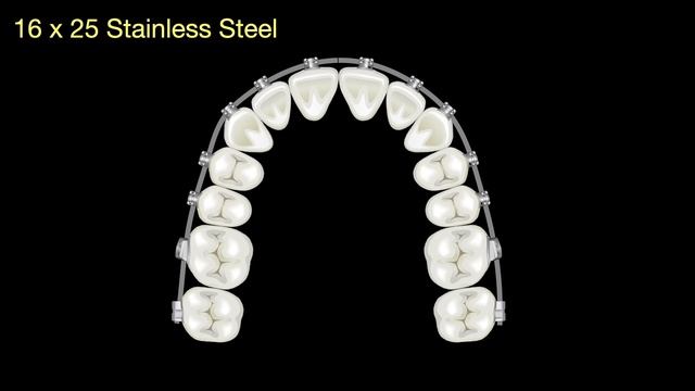 Solving anterior Openbite with Damon｜【Chris Chang Ortho】CC701 смотреть онлайн