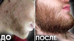 Нереальный БУСТ БОРОДЫ / Результат средств для роста бороды