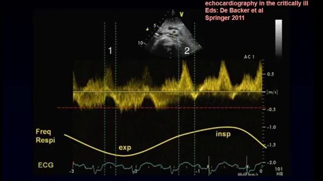 VA ECMO De Backer Daniel