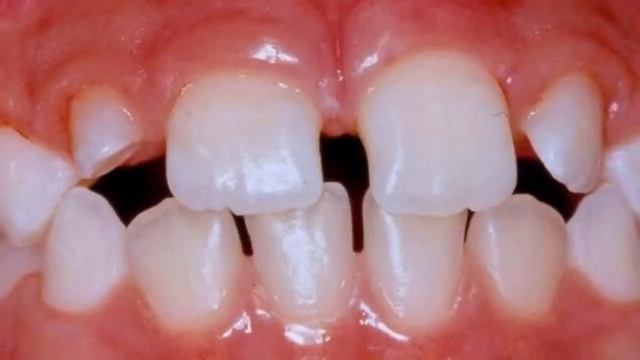 CEK GIGI MU !! BERIKUT KELAINAN TUMBUH KEMBANG GIGI !! смотреть онлайн