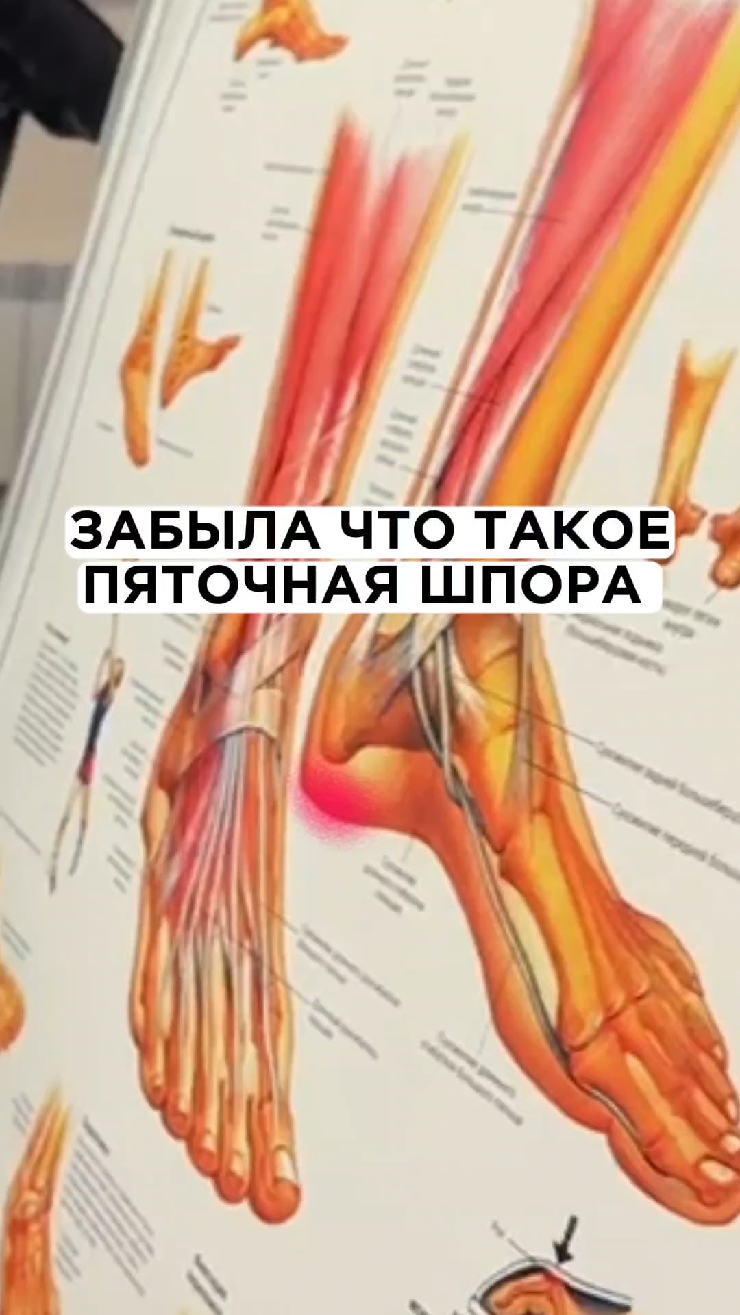 Исчезла пяточная шпора за 3 приёма #плоскостопие #стельки #шпора #пяточнаяшпора смотреть онлайн