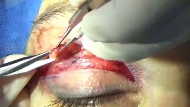 LACRIMAL GLAND PEXY смотреть онлайн