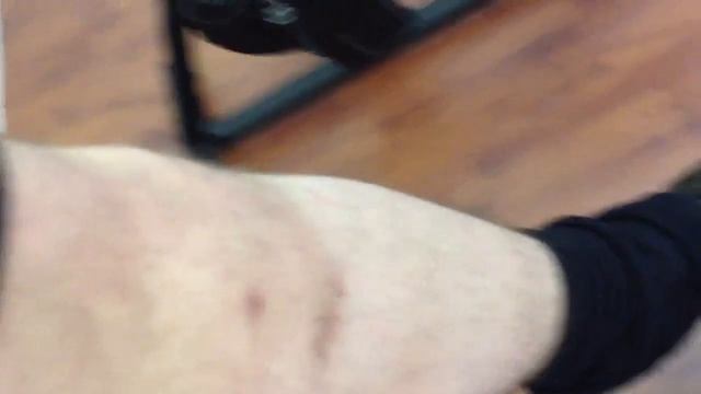 ACL and Meniscus surgery post op 5 weeks смотреть онлайн