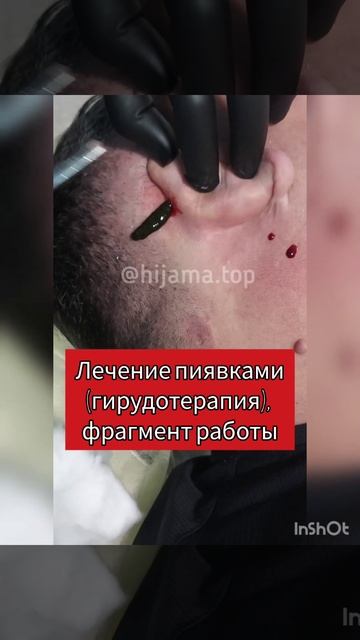 Лечение пиявками, гирудотерапия в Алматы #пиявки #гирудотерапия #гирудотерапевт #головныеболи смотреть онлайн