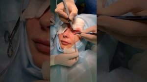 Трансконъюнктивальная нижняя блефаропластика