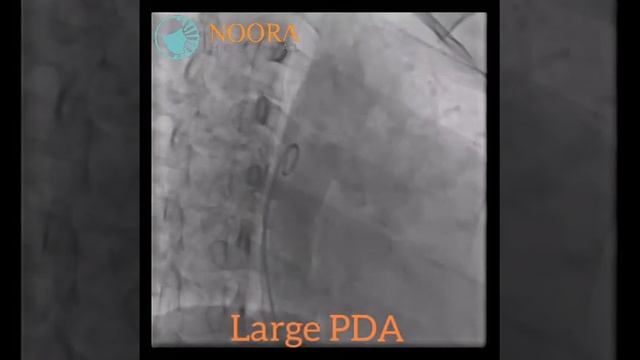 High risk Multivessel angioplasty and PDA device closure смотреть онлайн
