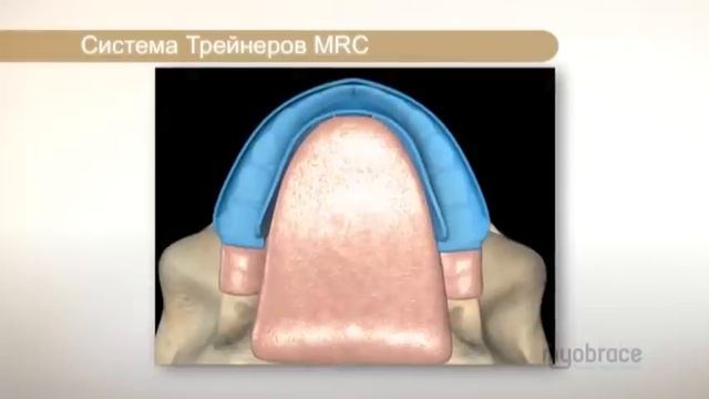 Myobrace информация для родителей и пациентов смотреть онлайн