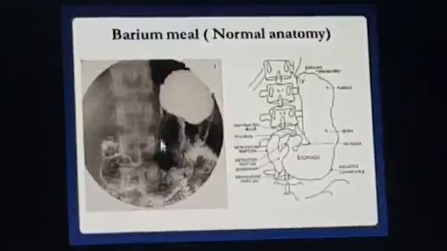 NORMAL BARIUM MEAL. смотреть онлайн