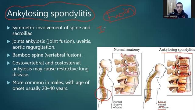 Sero Negative Spondyloarthritis USMLE STEP 1 شرح ال