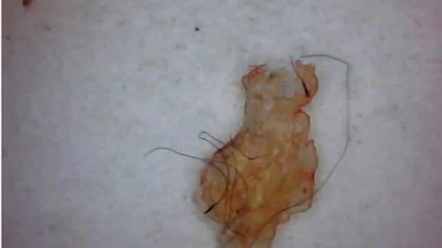 Shingle, Lyme, Fibromyalgia, Dermatitis, Eczema Is Morgellons Disease (Aspergillus Fumigatus) смотреть онлайн