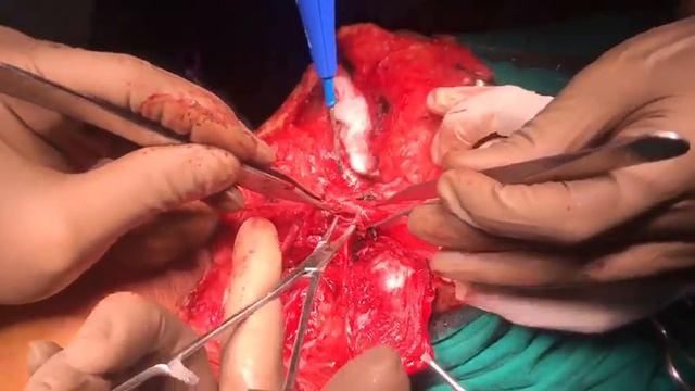 60 years old male suffering from left anterior 2/3 tongue carcinoma crossing midline. смотреть онлайн