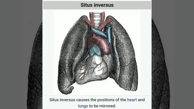 Situs inversus Dextrocardia #doctor #shortsfeed #short #short смотреть онлайн
