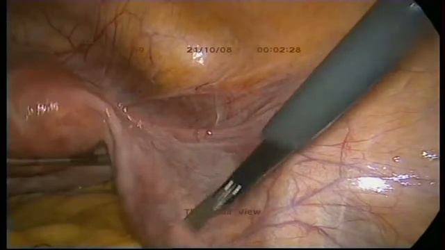 Kayıp RİA (hormonlu spiral) /Laparoscopic Removal of a Lost IUD (Mirena) смотреть онлайн