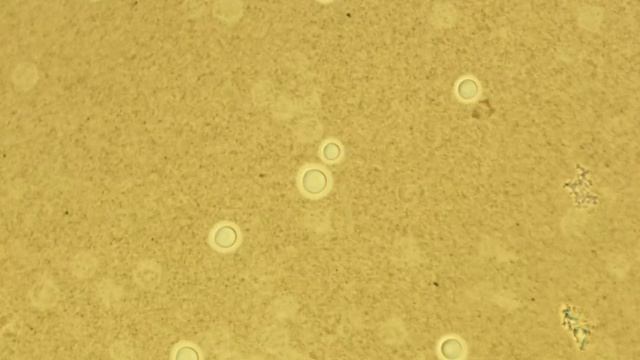 Cryptococcus spp on India ink preparation смотреть онлайн