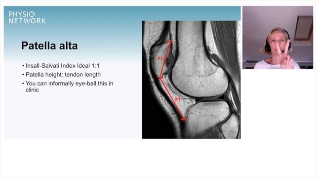 Assessing for a high patella for Knee Cap (Patellofemoral) Pain смотреть онлайн