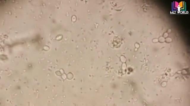 Yeast cells in urine microscopy. смотреть онлайн
