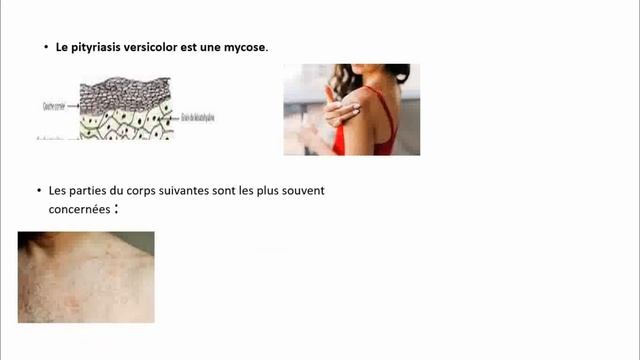 Comment guérir le Mycose cutanée? Pityriasis versicolor смотреть онлайн
