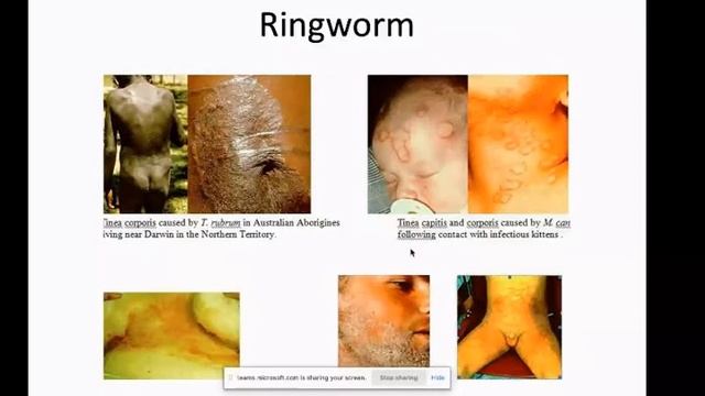 Microbiology Fungal skin infection смотреть онлайн