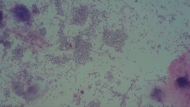 Gynaecology. Bacterial Vaginosis. Leptothrix.