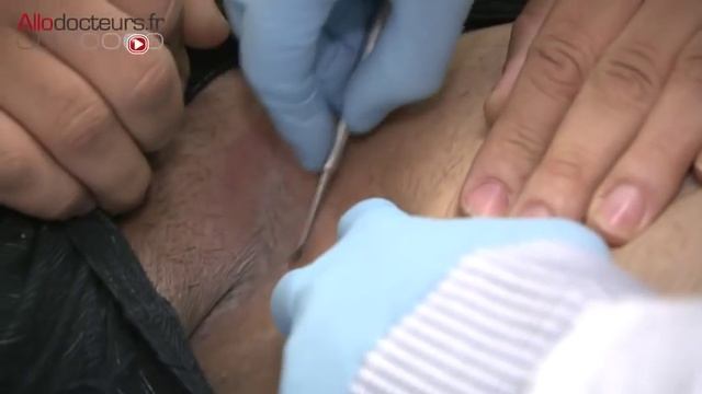 Le diagnostic des mycoses - Allo Docteurs смотреть онлайн
