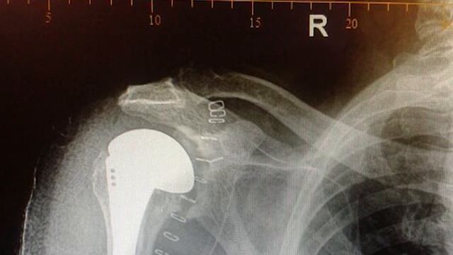 Couple Celebrates 30th Anniversary with Surgery in Cayman Islands смотреть онлайн